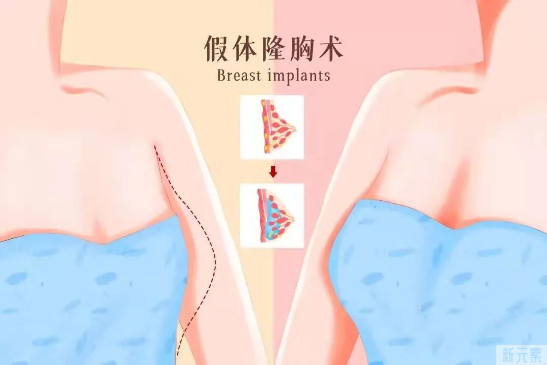 选择困难症:自体脂肪还是假体 图片-8