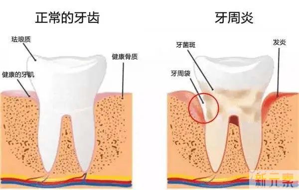 即刻种植VS传统种植，有什么区别，你更适合哪一个? 图片-9