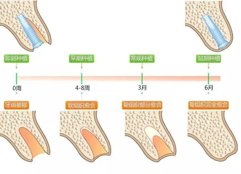 即刻种植VS传统种植，有什么区别，你更适合哪一个? 图片-6