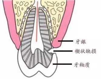 楔状缺损——仅仅是因为横向刷牙!? 图片-4