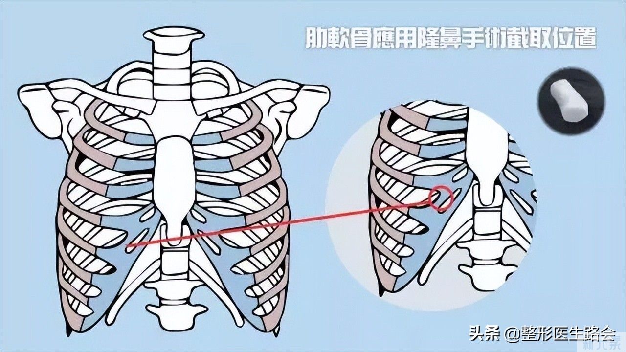 网络大热，医生热荐的“肋软骨鼻”真的那么好吗? 图片-3