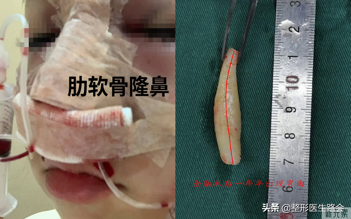 网络大热，医生热荐的“肋软骨鼻”真的那么好吗? 图片-4