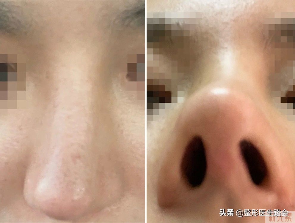 网络大热，医生热荐的“肋软骨鼻”真的那么好吗? 图片-8