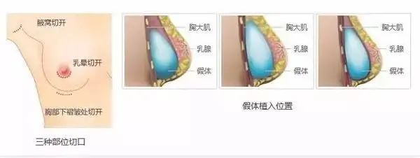 从A到C丰胸全靠按摩?别傻了，还是这个方法最实际! 图片-21