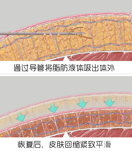 女生的假胯宽为何如此难瘦? 图片-11