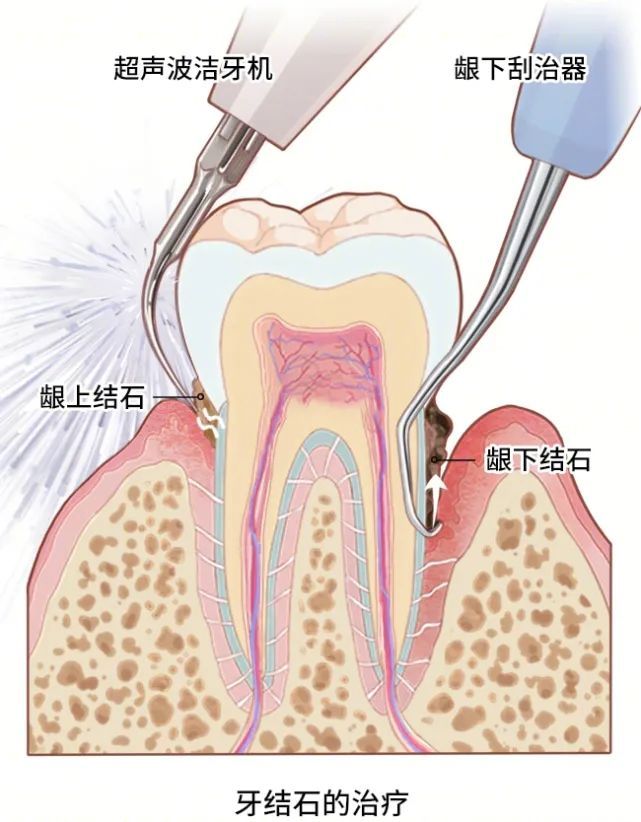 种牙先洗牙?注意，这可不是“多此一举”! 图片-8