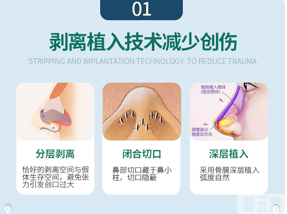 为什么玻尿酸隆鼻之后还想做假体/软骨鼻部整形 图片-7
