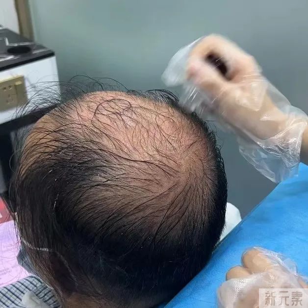 注意!缺发这些微量元素会导致脱发掉发哦~ 图片-9