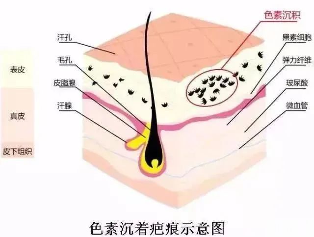伤口愈合后，为什么会出现色素沉着? 图片-5
