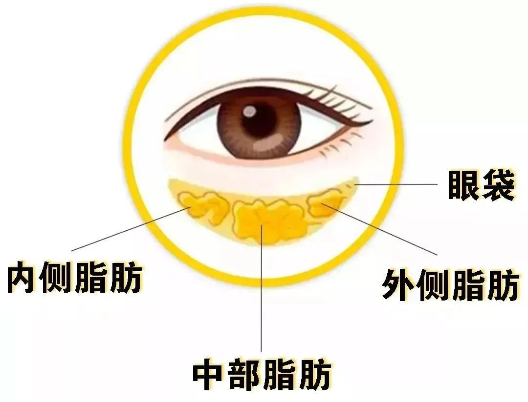 万年黑眼圈?老泪沟?眼袋?...这些眼周硬伤如何拯救? 图片-14