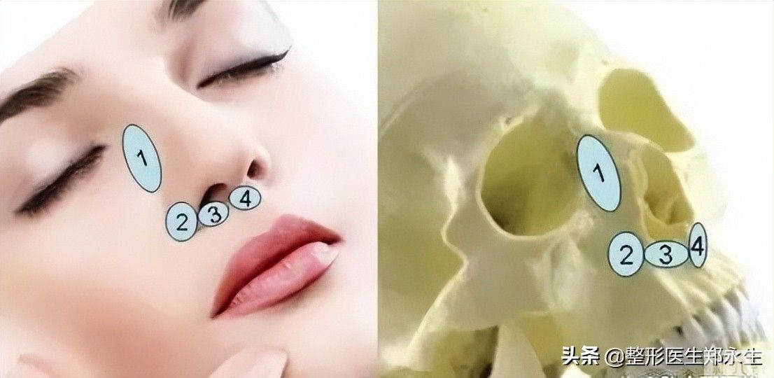 关于鼻基底填充，你必须要知道的几个问题 图片-2