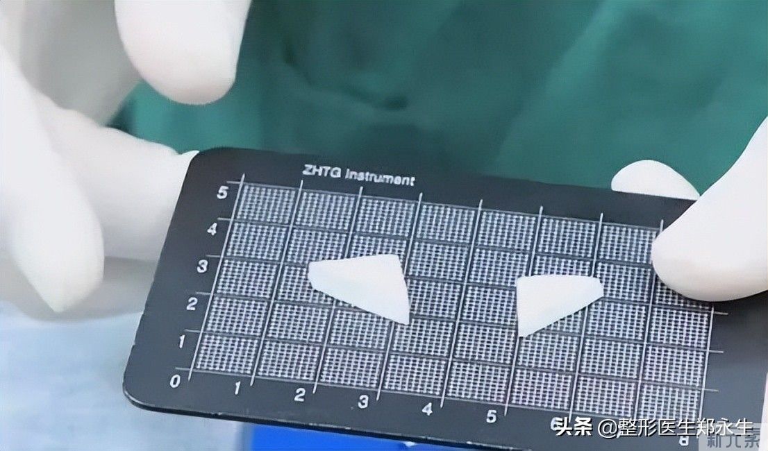 关于鼻基底填充，你必须要知道的几个问题 图片-3