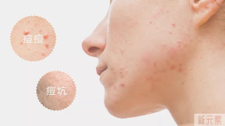 “痘坑”修复 图片-1