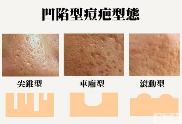 “痘坑”修复 图片-4
