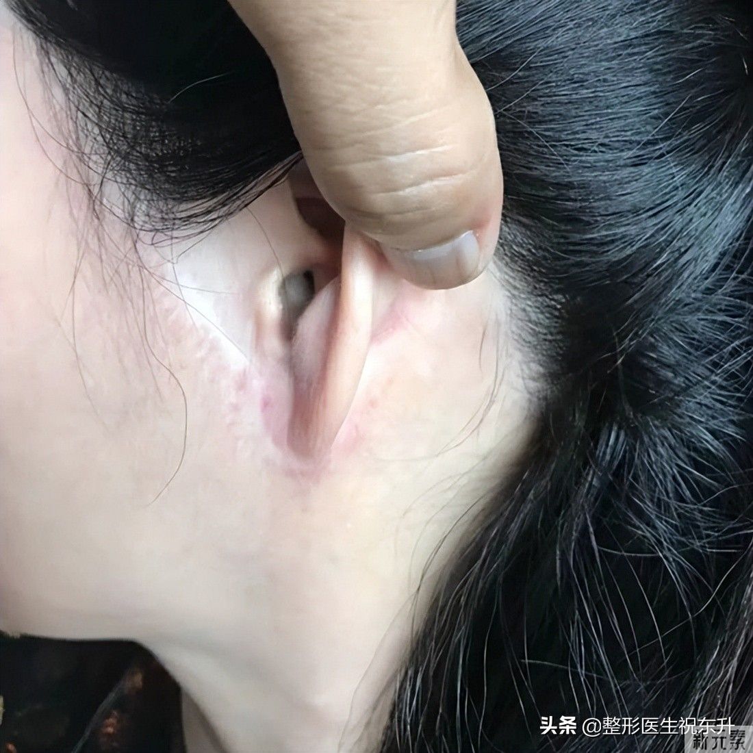 为什么有的人做了拉皮手术，会留下这样、那样难看的疤痕? 图片-1