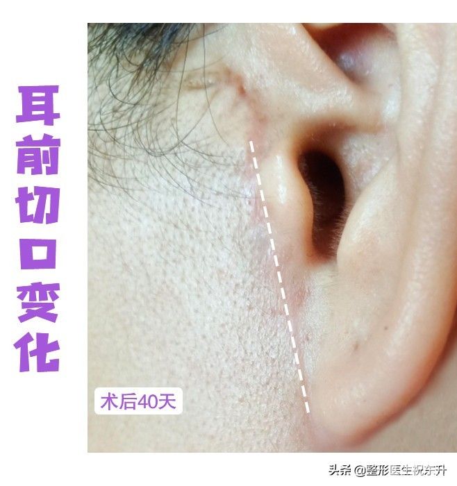 为什么有的人做了拉皮手术，会留下这样、那样难看的疤痕? 图片-3