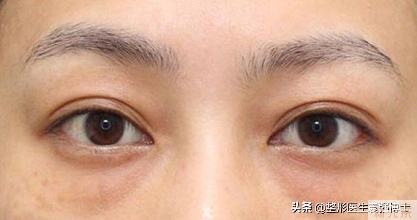 做过眼袋的人，说几句大实话，有些医生不会告诉你 图片-1