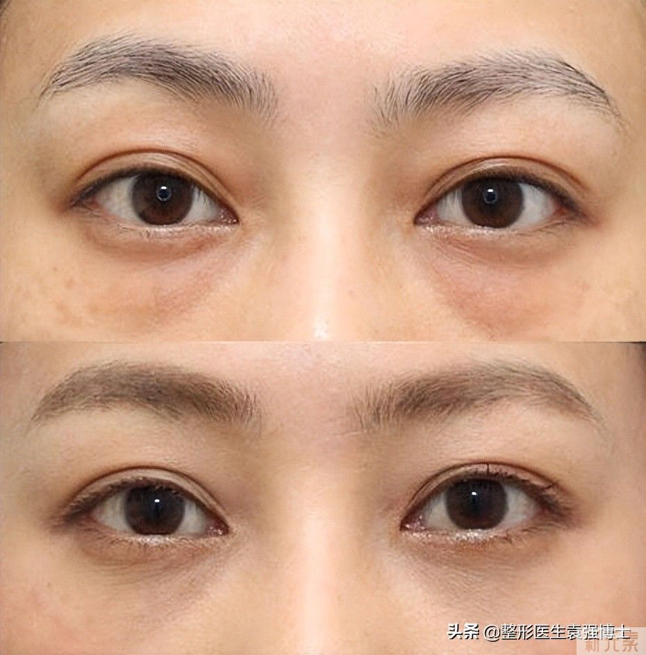 做过眼袋的人，说几句大实话，有些医生不会告诉你 图片-4