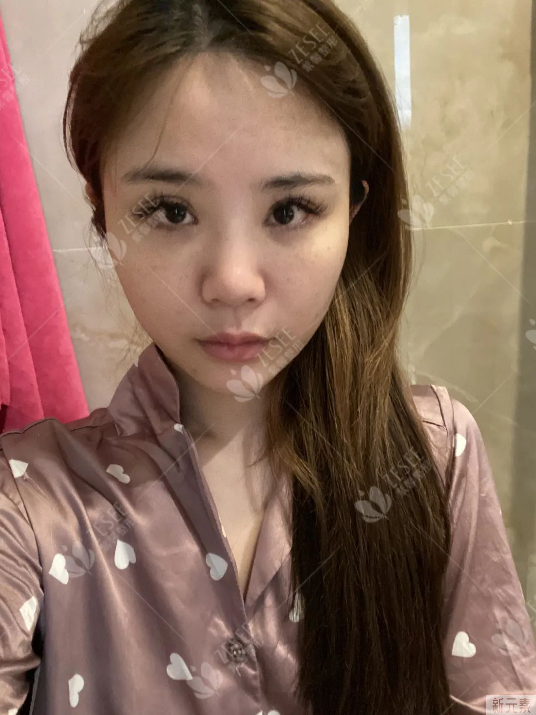 隆鼻是什么体验，我想你并不知道...... 图片-2