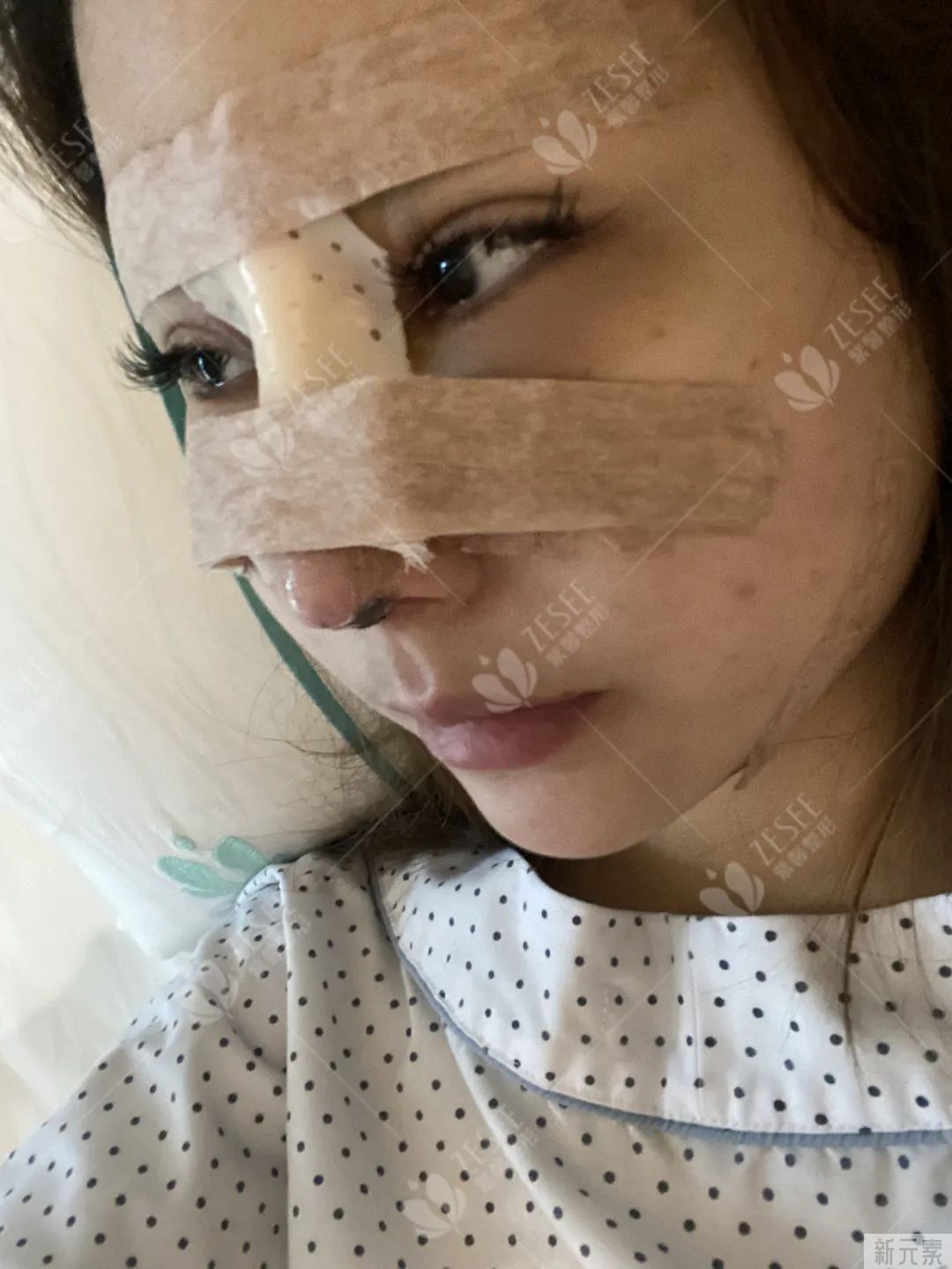 隆鼻是什么体验，我想你并不知道...... 图片-9