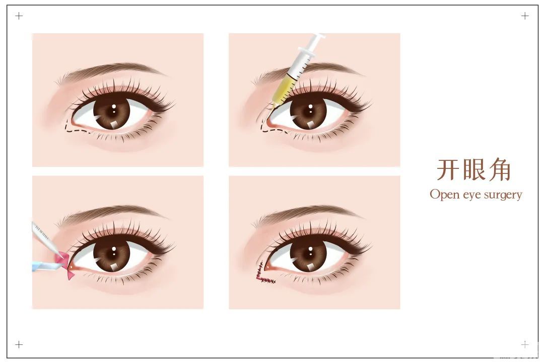 大小眼除了影响美观，背后还藏着这些··· 图片-9