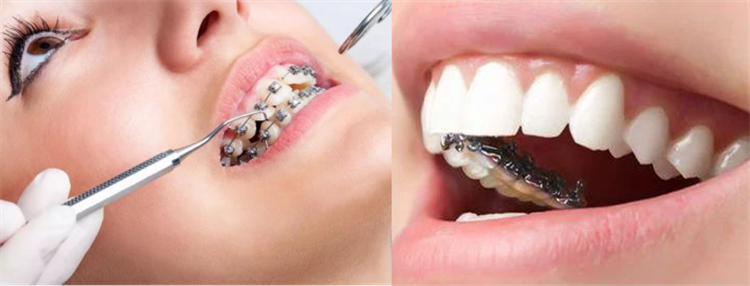 网购牙套做矫正?你可真是大冤种! 图片-11