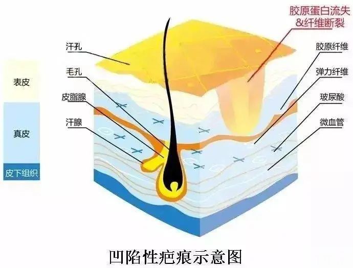 凹陷疤痕一旦形成，还能修复吗? 图片-4