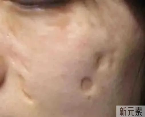 凹陷疤痕一旦形成，还能修复吗? 图片-2