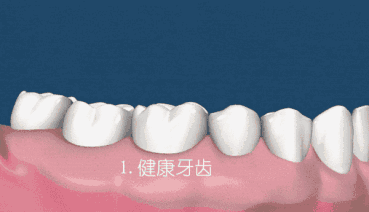 科普来了 | 怎么判断自己需不需要洗牙呢? 图片-13