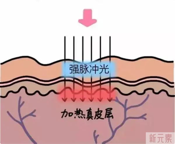 黄金超光子到底值不值得做?它和普通的光子嫩肤有何区别? 图片-8