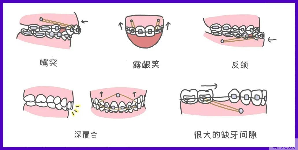 小身躯大作用，这个正畸利器了解下! 图片-7