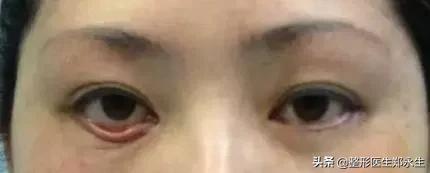 眼袋手术失败原因分析及修复方案 图片-2