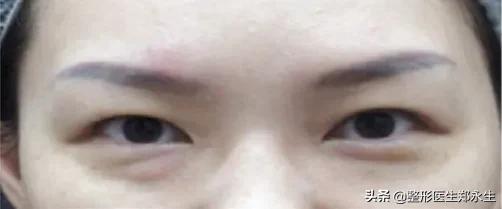 眼袋手术失败原因分析及修复方案 图片-4