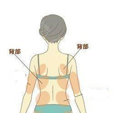 背部吸脂后注意事项，终于能理直气壮的发美背照片了 图片-7