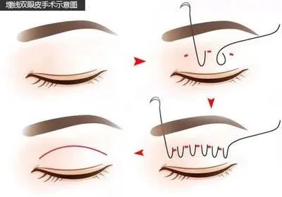 3分钟搞懂“眼鼻整前干货” 图片-9