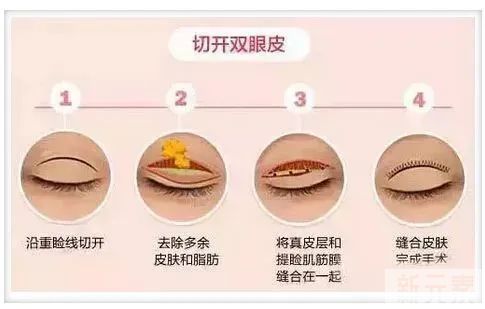 3分钟搞懂“眼鼻整前干货” 图片-10