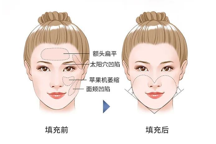 玻尿酸和水光有什么区别?如何避免馒化、填充自然? 图片-9
