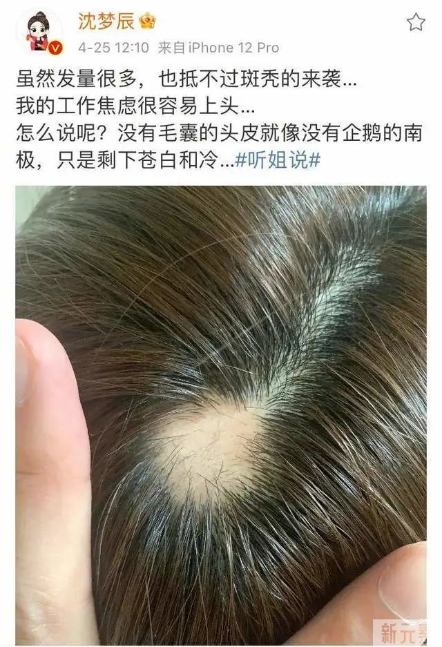 脱发几年了，还能再回到从前吗? 图片-12