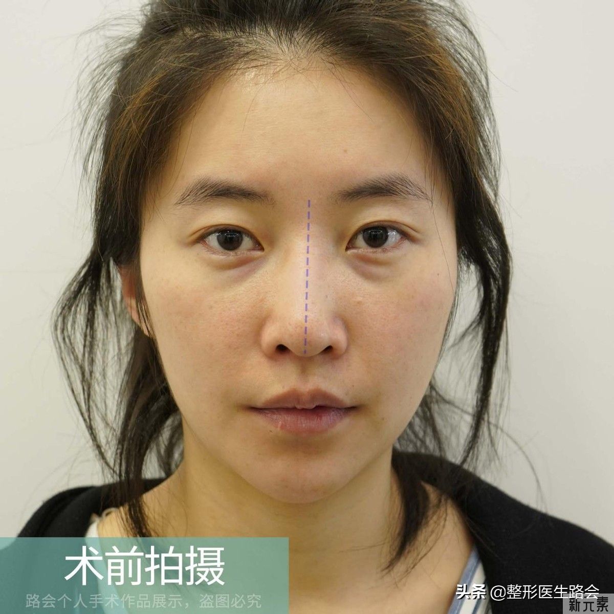 30岁姑娘鼻子+下巴修复，术后即刻到23天实拍，自然如“妈生” 图片-1