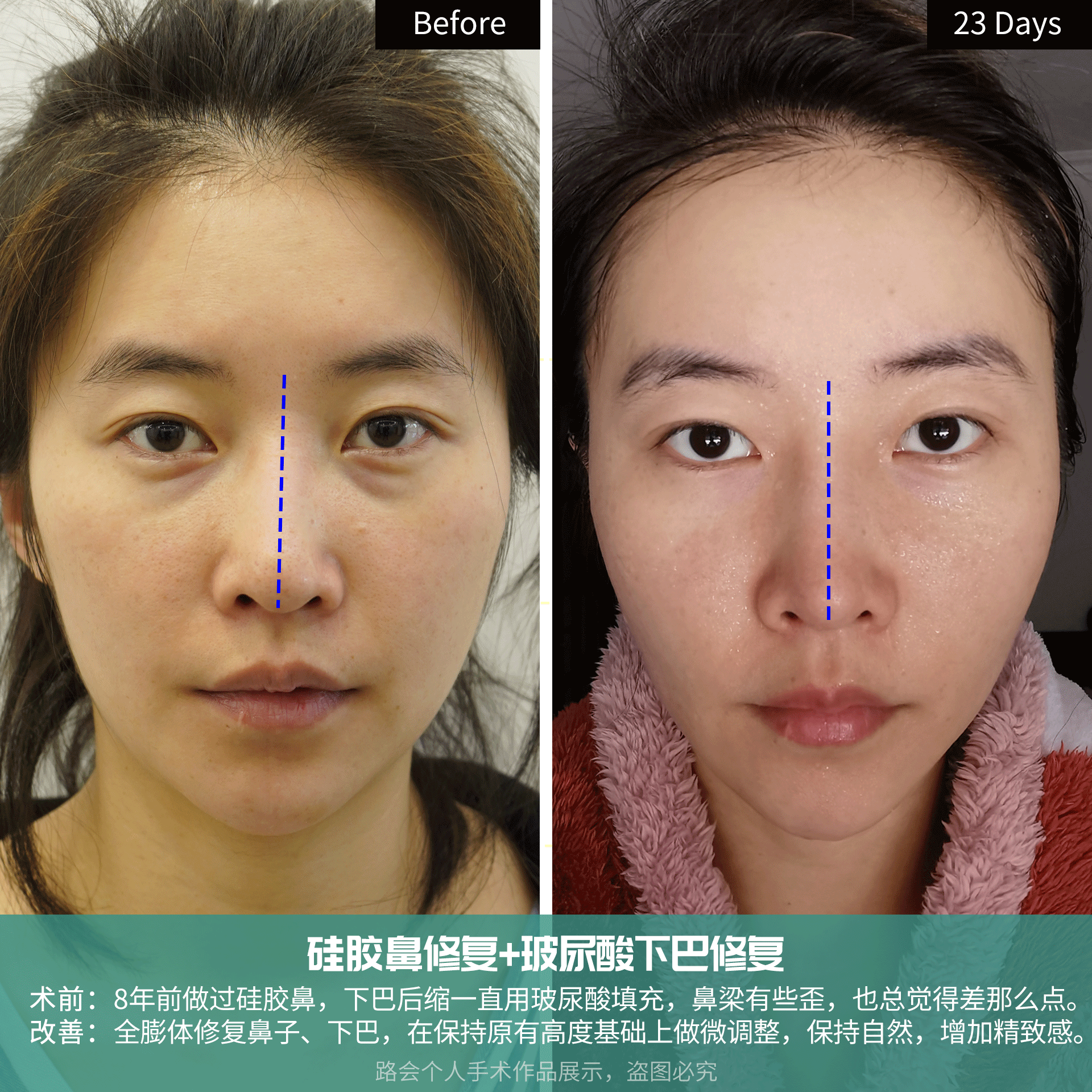 30岁姑娘鼻子+下巴修复，术后即刻到23天实拍，自然如“妈生” 图片-4