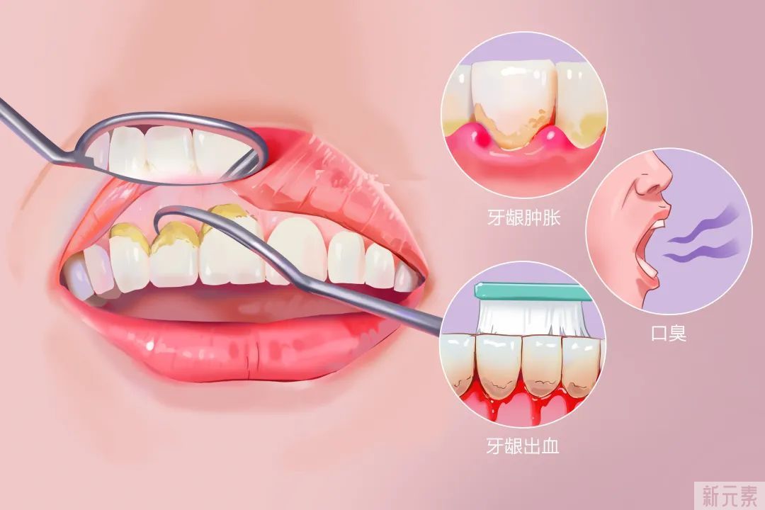 你的牙齿有结石吗?你知道牙结石为什么是臭的? 图片-7