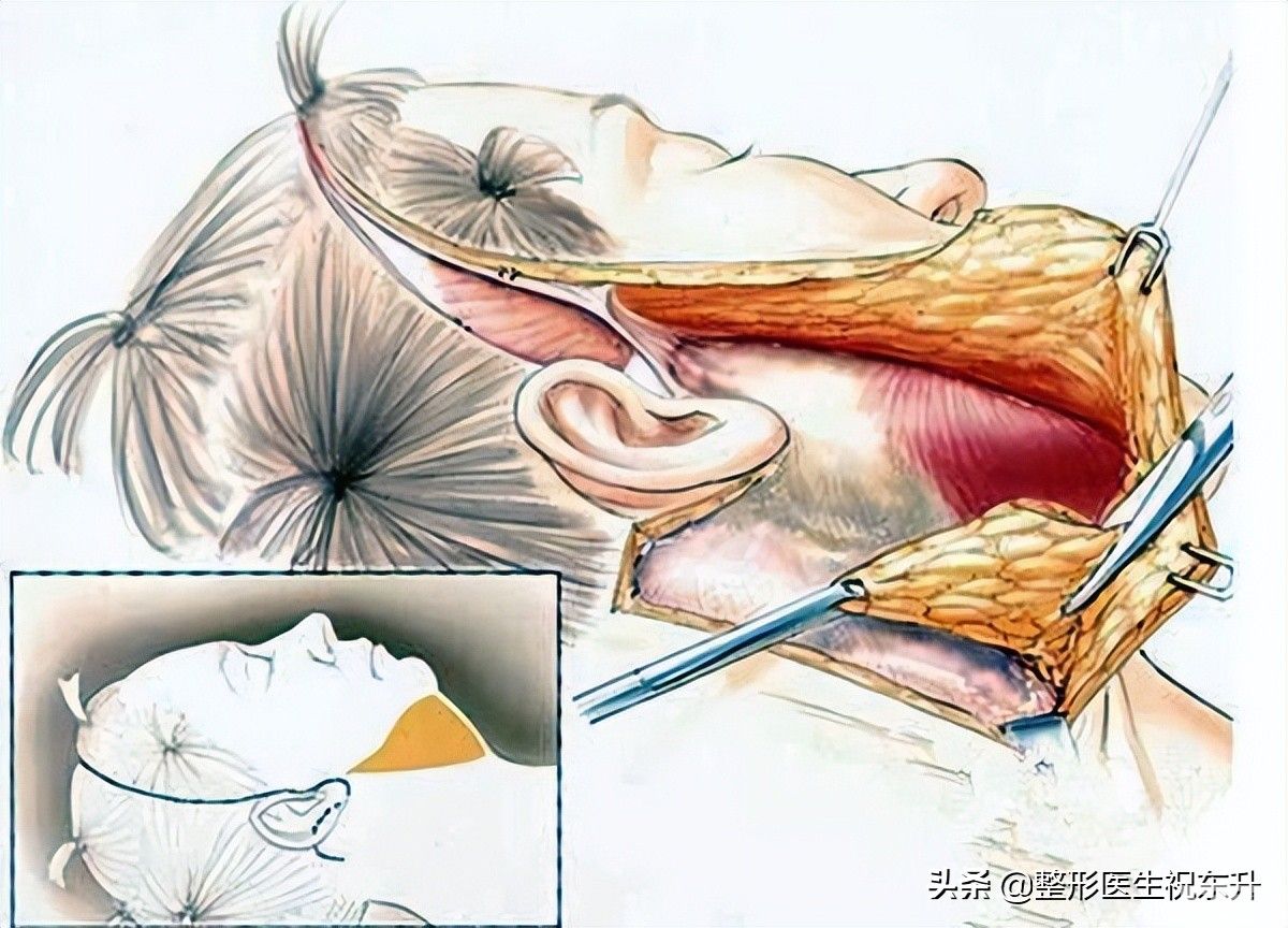 大拉皮手术的优缺点，以及一些真相 图片-1