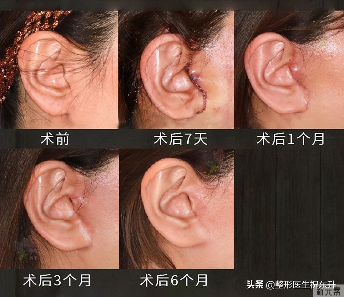 大拉皮手术的优缺点，以及一些真相 图片-2