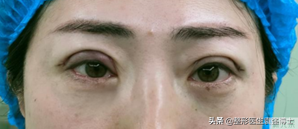 眼周抗衰2个月实拍记录，年轻逆袭小姐姐，主要痛感低 图片-3