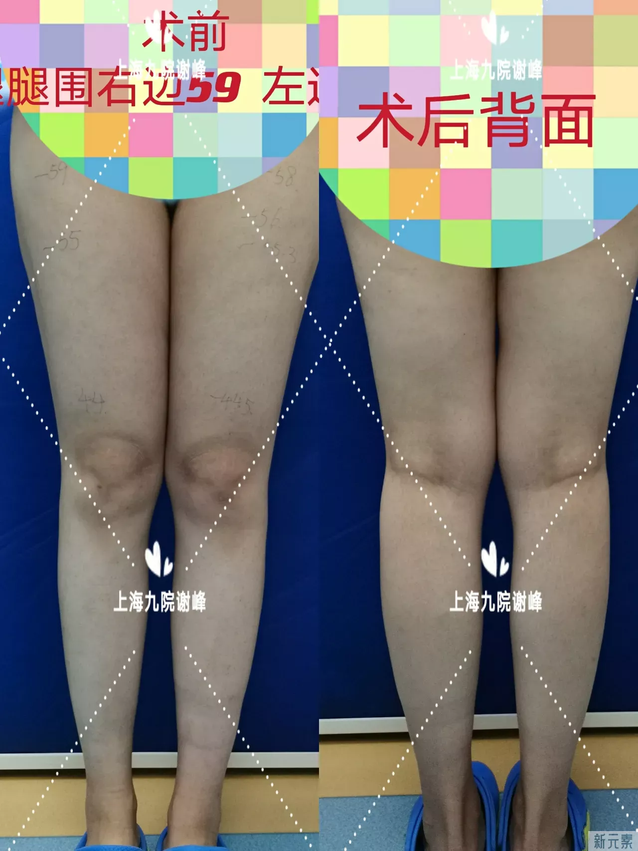 【吸脂专题】大腿腿围能瘦多少?   图片-1