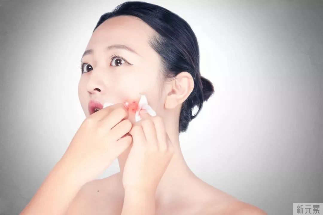 脸上长痘痘用手挤就好了?小心感染 图片-3