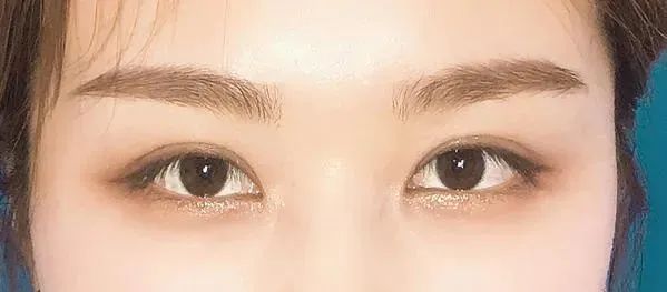 一定要看!双眼皮做失败的几个原因! 图片-2