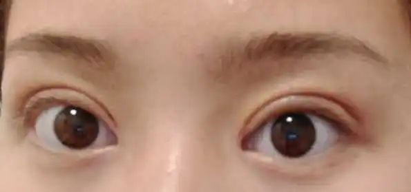 一定要看!双眼皮做失败的几个原因! 图片-6