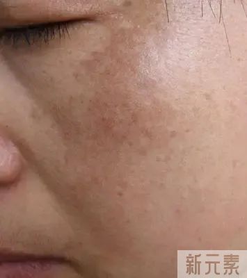 黄褐斑形成原因及治疗方法，建议收藏起来~ 图片-4
