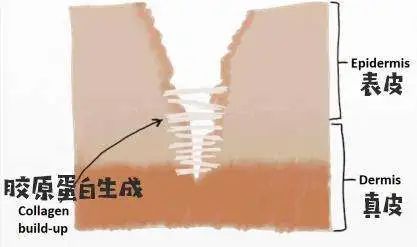 乳腺癌手术后如何预防疤痕?这篇文章跟您讲清楚! 图片-4